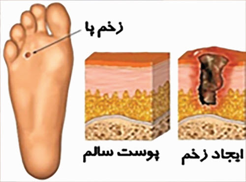 زخم دیابتی